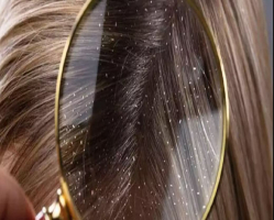 چگونه شوره مو را از بین ببریم ؟